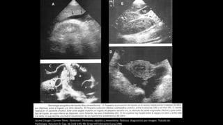 Jaume Llauger, Carmen Pérez. Abdomen: Peritoneo, epiplón y mesenterio. Pedrosa diagnóstico por imagen. Tratado de
Radiología. Volumen II. Cap. 36 (103-145)-Mc Graw-Hill-Interamericana.1986
A B
C
D
 