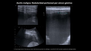 A. Teruel López Zurita, B. Díaz Barroso. Ascitis: Qué tenemos que decir los radiólogos. eram2012/S-1549. Sociedad española de radiología médica.
Ascitis maligna: Nodularidad peritoneal por cáncer gástrico
 