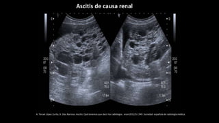 A. Teruel López Zurita, B. Díaz Barroso. Ascitis: Qué tenemos que decir los radiólogos. eram2012/S-1549. Sociedad española de radiología médica.
Ascitis de causa renal
 