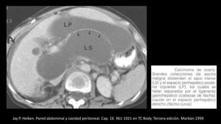 Jay P. Heiken. Pared abdominal y cavidad peritoneal. Cap. 16. 961-1021 en TC Body. Tercera edición. Marbán.1999
 