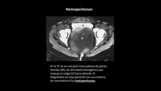 En la TC se ve una gran masa pélvica de partes
blandas (M), de densidad heterogénea,que
empuja la vejiga (V) hacia delante. El
diagnóstico en esta paciente con una historia
de traumatismo fue hemoperitoneo.
Hemoperitoneo
 