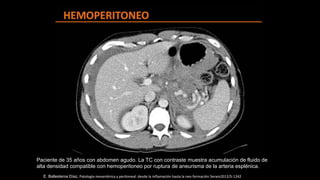 E. Ballesteros Díaz, Patología mesentérica y peritoneal: desde la inflamación hasta la neo formación Seram2012/S-1242
Paciente de 35 años con abdomen agudo. La TC con contraste muestra acumulación de fluido de
alta densidad compatible con hemoperitoneo por ruptura de aneurisma de la arteria esplénica.
 