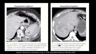 Federle. Peritoneo y mesenterio. Cap. 1: 9-39. Expertddx Abdomen Marbán 2015
 