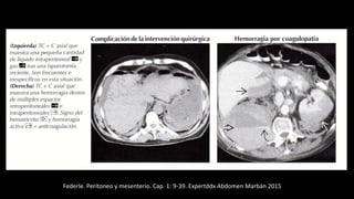 Federle. Peritoneo y mesenterio. Cap. 1: 9-39. Expertddx Abdomen Marbán 2015
 