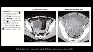Federle. Peritoneo y mesenterio. Cap. 1: 9-39. Expertddx Abdomen Marbán 2015
 