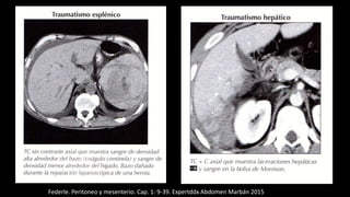 Federle. Peritoneo y mesenterio. Cap. 1: 9-39. Expertddx Abdomen Marbán 2015
 