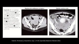 Federle. Peritoneo y mesenterio. Cap. 1: 9-39. Expertddx Abdomen Marbán 2015
 