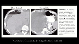 Federle. Peritoneo y mesenterio. Cap. 1: 9-39. Expertddx Abdomen Marbán 2015
 