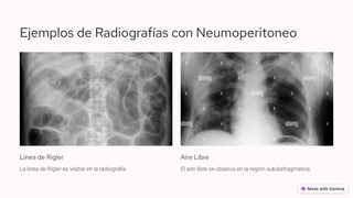 Sdinal De Rigler NeumoperitoneoCalcificaciones-en Abdominales - LeonaA Diego.pdf