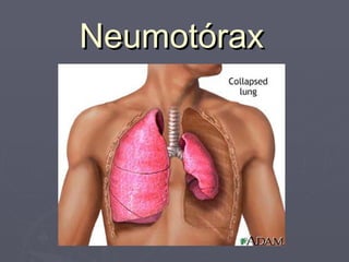 Neumotórax
 