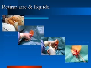 Retirar aire & líquido



  Elegir el sitio


                                                                               Suturar el tubo al tórax

                             Explorar con el dedo



                                                Colocar el tubo con la pinza
Photos courtesy trauma.org
 