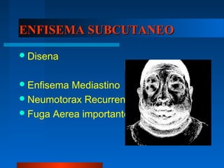 ENFISEMA SUBCUTANEO
 Disena


 Enfisema Mediastino
 Neumotorax Recurrente
 Fuga Aerea importante
 