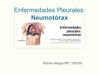 Enfermedades Pleurales:
     Neumotórax




         Daniel Aliaga NP: 102329
 