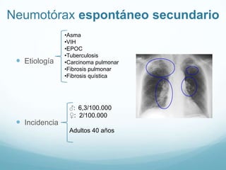Neumotórax espontáneo secundario
                •Asma
                •VIH
                •EPOC
                •Tuberculosis
  Etiología    •Carcinoma pulmonar
                •Fibrosis pulmonar
                •Fibrosis quística




                 ♂: 6,3/100.000
                 ♀: 2/100.000
  Incidencia
                 Adultos 40 años
 