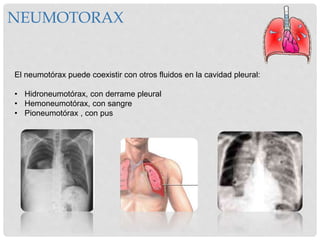 NEUMOTORAX
El neumotórax puede coexistir con otros fluidos en la cavidad pleural:
• Hidroneumotórax, con derrame pleural
• Hemoneumotórax, con sangre
• Pioneumotórax , con pus
 