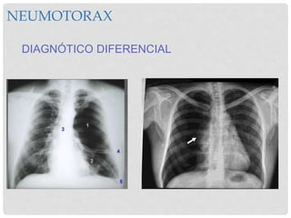 NEUMOTORAX
DIAGNÓTICO DIFERENCIAL
 