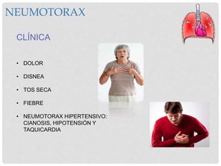 NEUMOTORAX
CLÍNICA
• DOLOR
• DISNEA
• TOS SECA
• FIEBRE
• NEUMOTORAX HIPERTENSIVO:
CIANOSIS, HIPOTENSIÓN Y
TAQUICARDIA
 