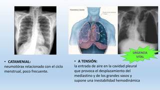 • CATAMENIAL:
neumotórax relacionado con el ciclo
menstrual, poco frecuente.
• A TENSIÓN:
la entrada de aire en la cavidad pleural
que provoca el desplazamiento del
mediastino y de los grandes vasos y
supone una inestabilidad hemodinámica
URGENCIA
VITAL
 