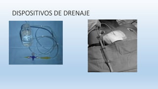 DISPOSITIVOS DE DRENAJE
 