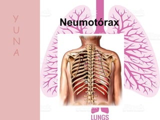 NeumotóraxY
U
N
A
 
