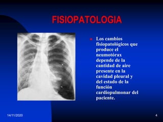 14/11/2020 4
FISIOPATOLOGIA
 Los cambios
fisiopatológicos que
produce el
neumotórax
depende de la
cantidad de aire
presente en la
cavidad pleural y
del estado de la
función
cardiopulmonar del
paciente.
 