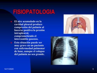 14/11/2020 5
FISIOPATOLOGIA
 El aire acumulado en la
cavidad pleural produce
compresión del pulmón al
hacerse positiva la presión
intrapleural,
comprometiendo el
intercambio gaseoso.
 Esta situación puede ser
muy grave en un paciente
con enfermedad pulmonar
de base, aunque el colapso
del pulmón no sea grande.
 