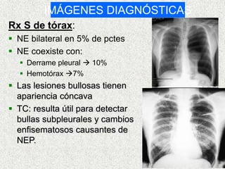 IMÁGENES DIAGNÓSTICAS
Rx S de tórax:
 NE bilateral en 5% de pctes
 NE coexiste con:
 Derrame pleural  10%
 Hemotórax 7%
 Las lesiones bullosas tienen
apariencia cóncava
 TC: resulta útil para detectar
bullas subpleurales y cambios
enfisematosos causantes de
NEP.
 