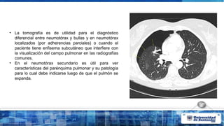 • La tomografía es de utilidad para el diagnóstico
diferencial entre neumotórax y bullas y en neumotórax
localizados (por adherencias parciales) o cuando el
paciente tiene enfisema subcutáneo que interfiere con
la visualización del campo pulmonar en las radiografías
comunes.
• En el neumotórax secundario es útil para ver
características del parénquima pulmonar y su patología
para lo cual debe indicarse luego de que el pulmón se
expanda.
 