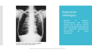 Exploración
radiológica.
 RAYOS X SIMPLE:
Demostración del margen
externo de la pleura visceral
separa de la pleura parietal, por
una expansión transparente
desprovisto de vasos
vasculares
FIshman,A:P 2022, Pulmonary deseases and disordderes.Mc Graw Hill capitulo 79.
 