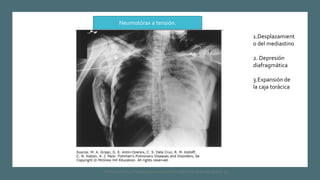 1.Desplazamient
o del mediastino
2. Depresión
diafragmática
3.Expansión de
la caja torácica
Neumotórax a tensión.
FIshman,A:P 2022, Pulmonary deseases and disordderes.Mc Graw Hill capitulo 79.
 