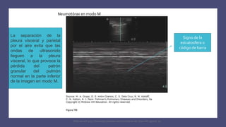 Signo de la
estratosfera o
código de barra
Neumotórax en modo M
La separación de la
pleura visceral y parietal
por el aire evita que las
ondas de ultrasonido
lleguen a la pleura
visceral, lo que provoca la
pérdida del patrón
granular del pulmón
normal en la parte inferior
de la imagen en modo M.
FIshman,A:P 2022, Pulmonary deseases and disordderes.Mc Graw Hill capitulo 79.
 