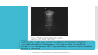 Las líneas A se ven como una serie de líneas blancas horizontales equidistantes y
profundas hasta la pleura. Se observan en pulmones normales, pero también en
neumotórax, embolia pulmonar, EPOC o asma debido a reverberaciones entre la pleura
parietal y el transductor.
FIshman,A:P 2022, Pulmonary deseases and disordderes.Mc Graw Hill capitulo 79.
 