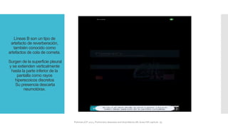 Líneas B son un tipo de
artefacto de reverberación,
también conocido como
artefactos de cola de cometa.
Surgen de la superficie pleural
y se extienden verticalmente
hasta la parte inferior de la
pantalla como rayos
hiperecoicos discretos
Su presencia descarta
neumotórax.
FIshman,A:P 2022, Pulmonary deseases and disordderes.Mc Graw Hill capitulo 79.
 