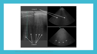 FIshman,A:P 2022, Pulmonary deseases and disordderes.Mc Graw Hill capitulo 79.
 