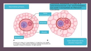 Vaina
broncovascular
Arteriola
Alveolo
Bronquiolo
Sobre distensión de los
alveolos marginales
Diseccionar medialmente a lo largo de la
vaina broncovascular y dar neumomediastino,
que puede ir acompañado de inflamación
subcutánea.
Neumotórax primario.
 
