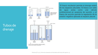 Tubos de
drenaje
El frasco recolector permite el drenaje estéril
de los espacios pleurales. El frasco con sello
de agua actúa como una válvula
unidireccional en ausencia de succión, y el
frasco de succión permite la regulación de la
presión negativa aplicada al espacio pleural
FIshman,A:P 2022, Pulmonary deseases and disordderes.Mc Graw Hill capitulo 79.
 