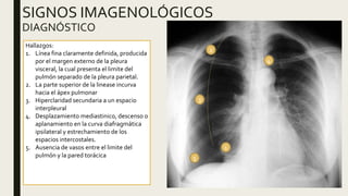 SIGNOS IMAGENOLÓGICOS
DIAGNÓSTICO
Hallazgos:
1. Línea fina claramente definida, producida
por el margen externo de la pleura
visceral, la cual presenta el limite del
pulmón separado de la pleura parietal.
2. La parte superior de la linease incurva
hacia el ápex pulmonar
3. Hiperclaridad secundaria a un espacio
interpleural
4. Desplazamiento mediastinico, descenso o
aplanamiento en la curva diafragmática
ipsilateral y estrechamiento de los
espacios intercostales.
5. Ausencia de vasos entre el limite del
pulmón y la pared torácica
1
2
3
4
5
 