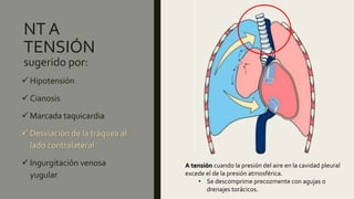 NT A
TENSIÓN
sugerido por:
 Hipotensión
 Cianosis
 Marcada taquicardia
 Desviación de la tráquea al
lado contralateral
 Ingurgitación venosa
yugular
A tensión cuando la presión del aire en la cavidad pleural
excede el de la presión atmosférica.
• Se descomprime precozmente con agujas o
drenajes torácicos.
 