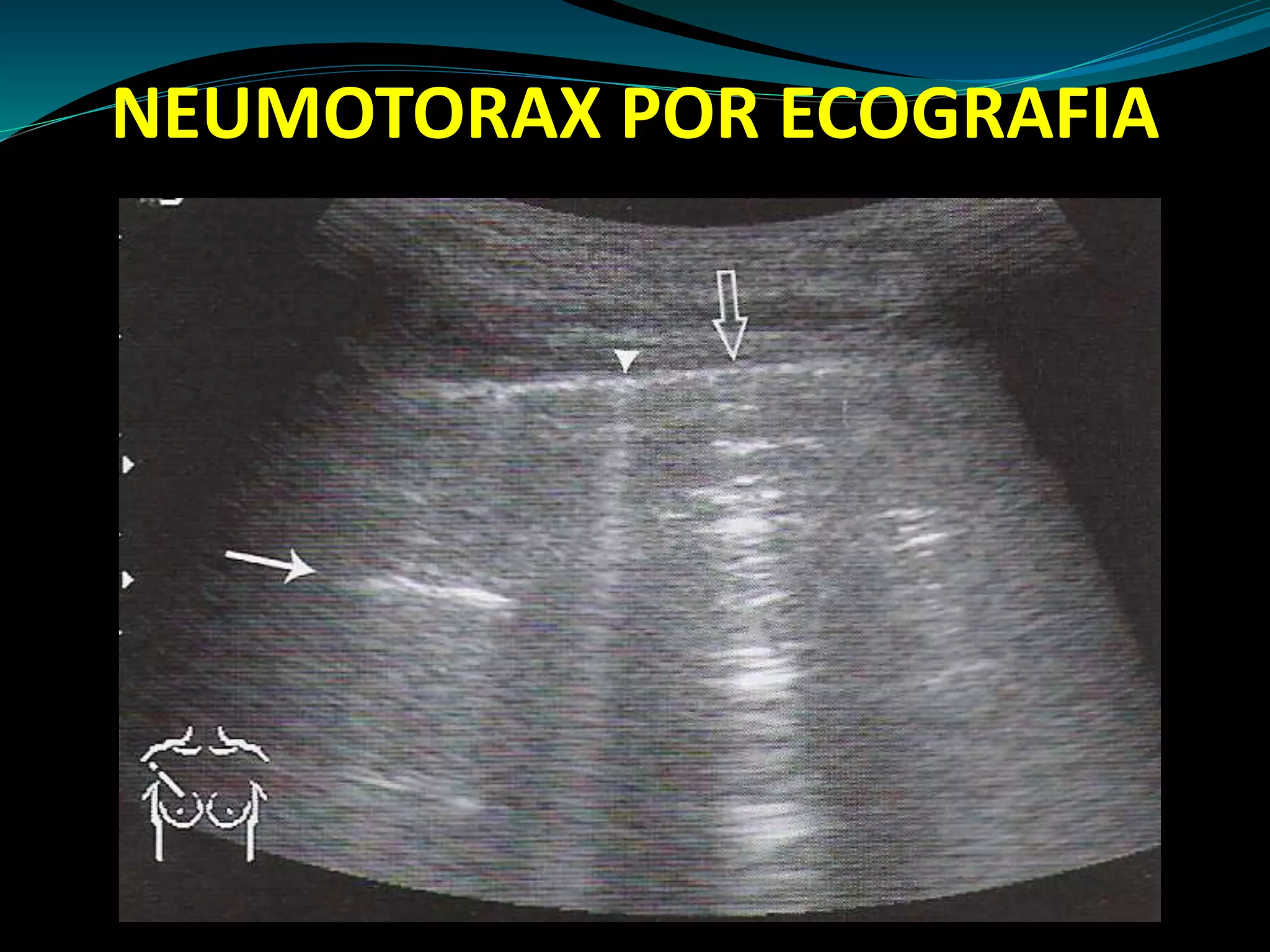 Neumotorax 2015 | PPT