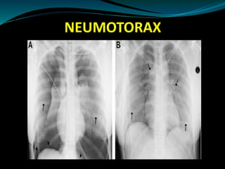 NEUMOTORAX
 