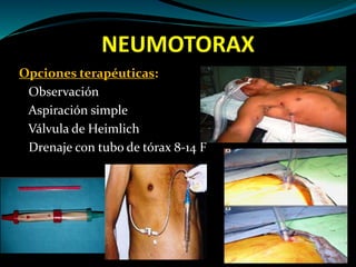 NEUMOTORAX
Opciones terapéuticas:
Observación
Aspiración simple
Válvula de Heimlich
Drenaje con tubo de tórax 8-14 F
 