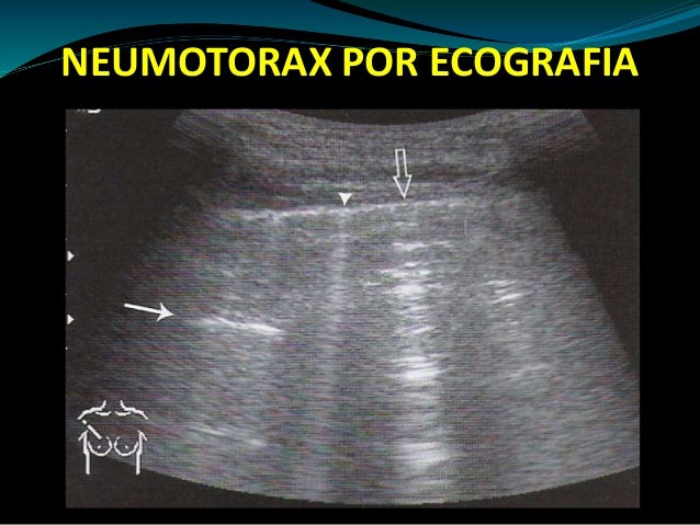 neumotorax-2015