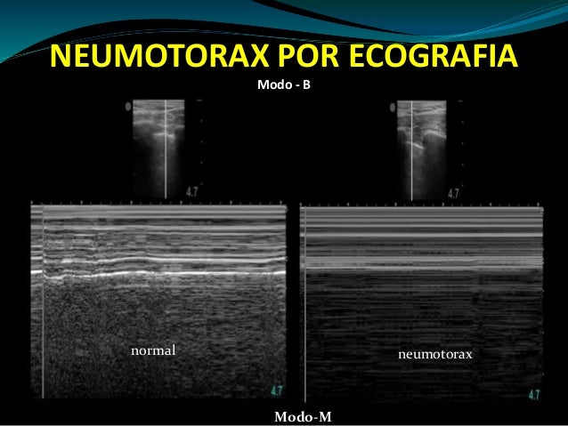 Neumotorax 2015