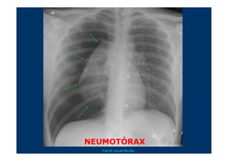 Neotrax Rt CLASE DE NEUMOTORAX PARA ALUMNOS DE CLÍNICA QUIRURGICA | PDF