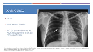 DIAGNÓSTICO
 Clínica
 Rx PA de tórax y lateral
 TAC: útil cuando el tamaño del
neumotórax es menor a 15% del
hemitórax afectado
 