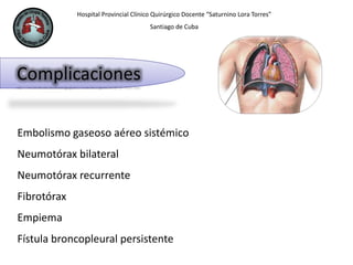 Hospital Provincial Clínico Quirúrgico Docente “Saturnino Lora Torres”
Santiago de Cuba
Complicaciones
Embolismo gaseoso aéreo sistémico
Neumotórax bilateral
Neumotórax recurrente
Fibrotórax
Empiema
Fístula broncopleural persistente
 