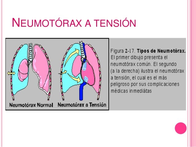 NEUMOTORAX A TENSION EPUB NEUMOTORAX A TENSION EPUB
