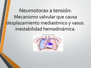 Neumotorax a tensión:
Mecanismo valvular que causa
desplazamiento mediastinico y vasos.
Inestabilidad hemodinámica.
 