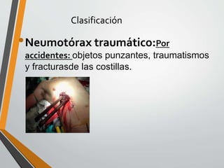 Clasificación
•Neumotórax traumático:Por
accidentes: objetos punzantes, traumatismos
y fracturasde las costillas.
 