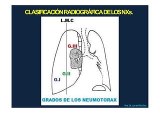 CLASIFICACIÓNRADIOGRÁFICADELOSNXs.
Prof.Dr
.Luis del RioDiez
 